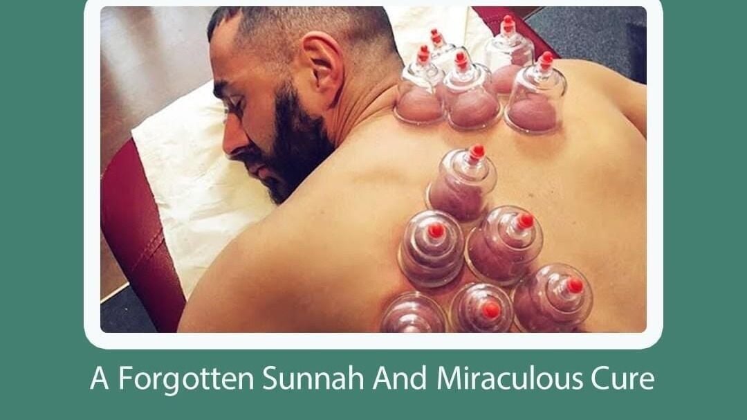 Wet cupping (hijama) cups placed across the back
