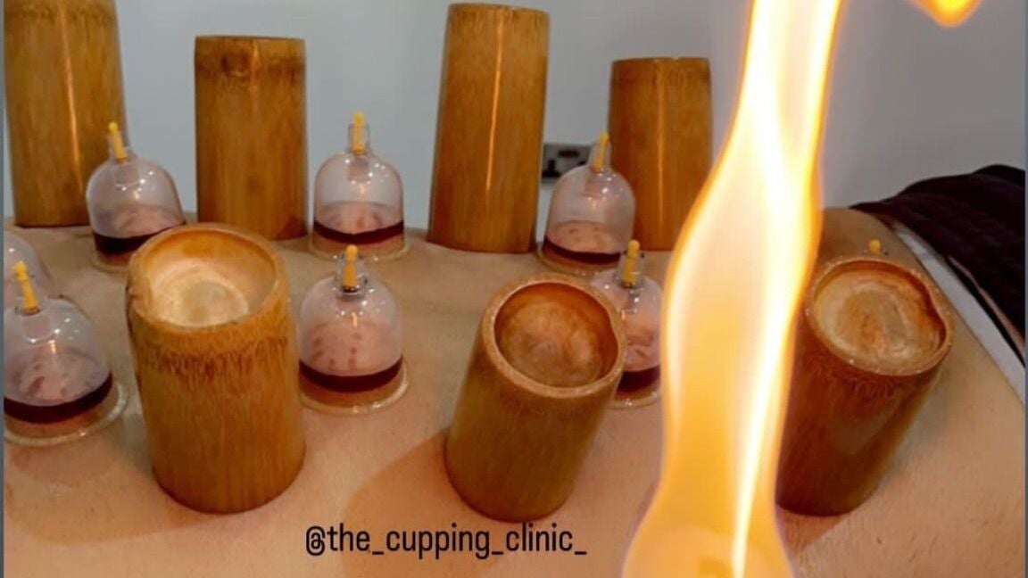 Traditional fire cupping treatment at The Cupping Clinic Blackburn